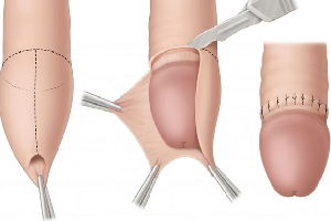 Robotic Surgery