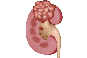 Kidney Cancer