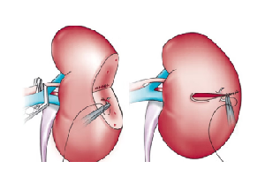 Robotic Surgery