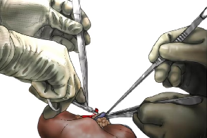 kidney Transplant