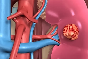 Robotic Surgery