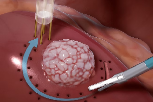 Robotic Surgery