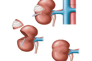 Robotic Surgery