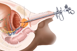 Robotic Surgery
