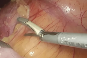 Robotic Surgery