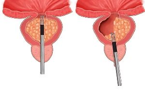 Robotic Surgery