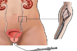 Robotic Surgery